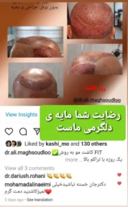 رضایت از کاشت مو به روش FIT