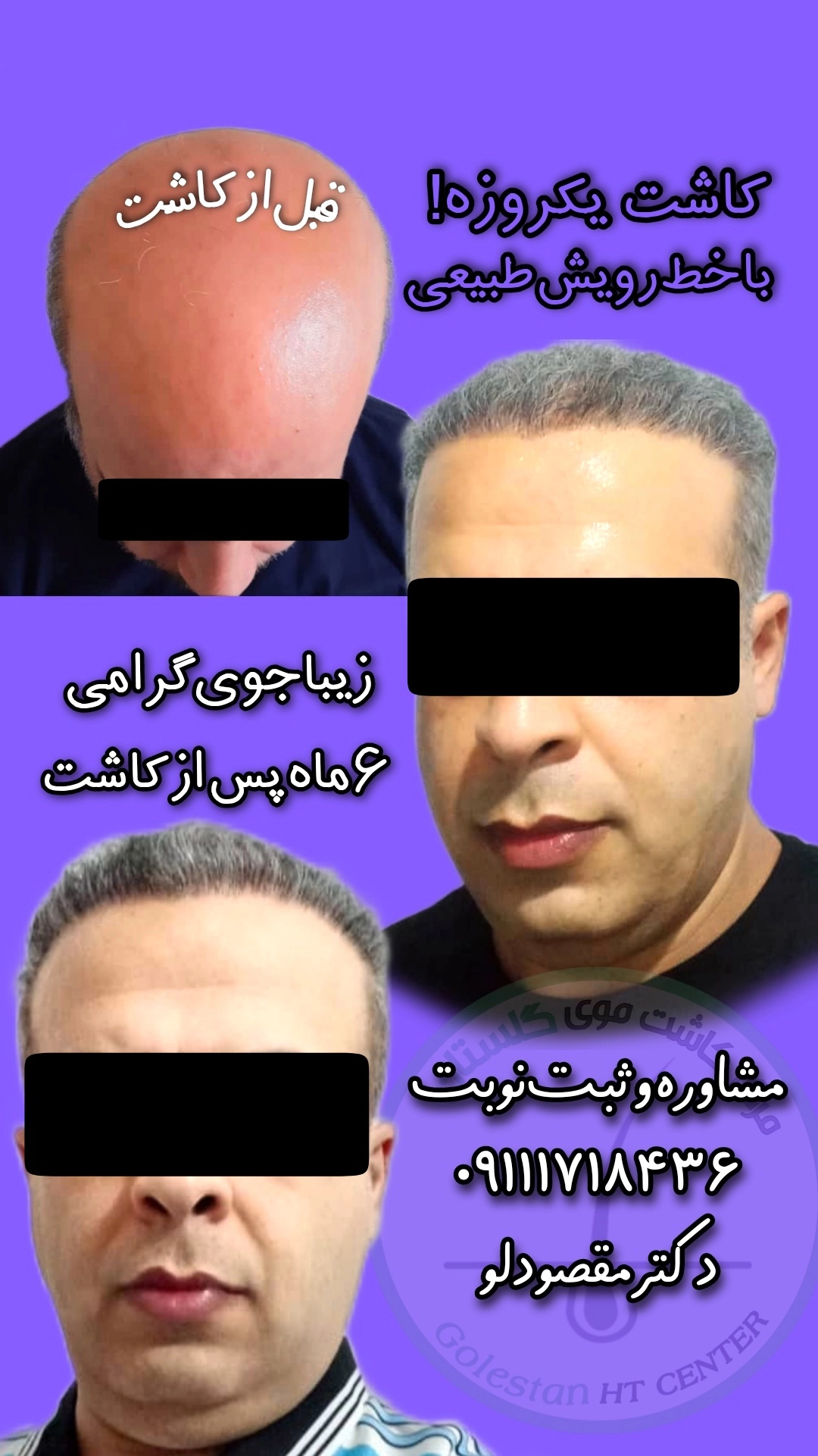 قبل و بعد از کاشت مو 11