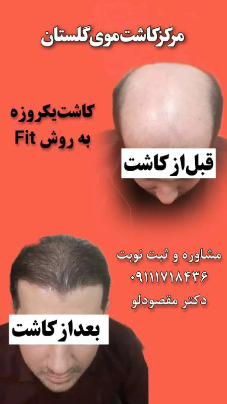 قبل و بعد از کاشت مو 7