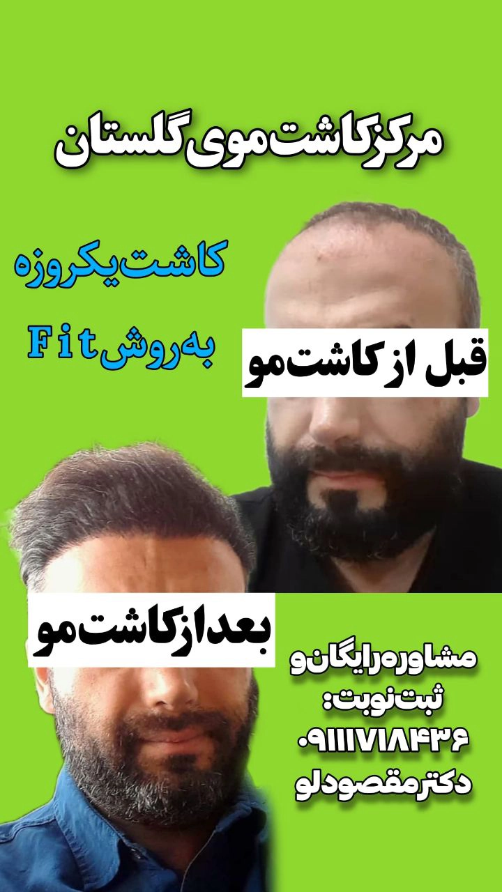 قبل و بعد از کاشت مو 8