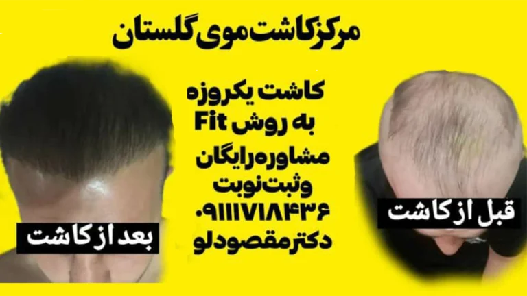 نتیجه کاشت مو در گرگان دکتر مقصودلو1