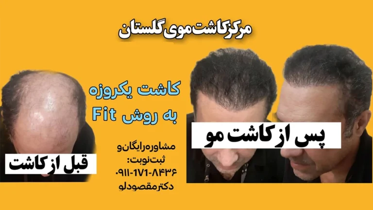 نتیجه کاشت مو در گرگان دکتر مقصودلو1
